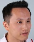 After Hair Transplant&nbsp;Front
